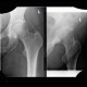 Reactive arthritis, arthritis in salmonellosis, salmonella: X-ray - Plain radiograph